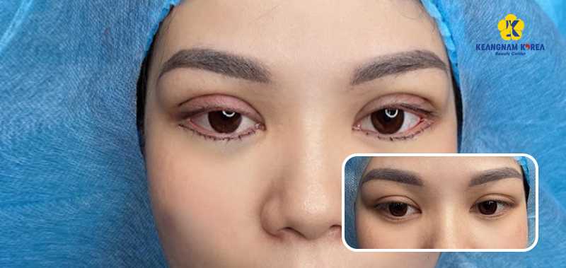 lower eyelid blepharoplasty at Keangnam Korea