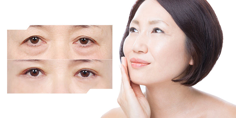 Does lower eyelid blepharoplasty Leave Scars?