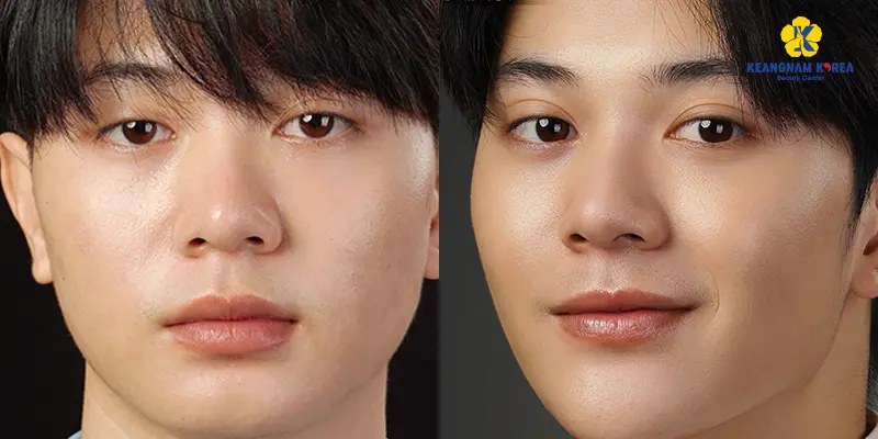 Eyelid Surgery for Men at Keangnam Korea