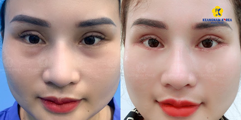 Image of lower eyelid blepharoplasty at Keangnam Korea