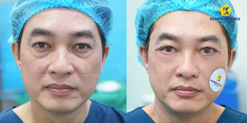 Lower eyelid fat removal helps to improve appearance and restore facial harmony.