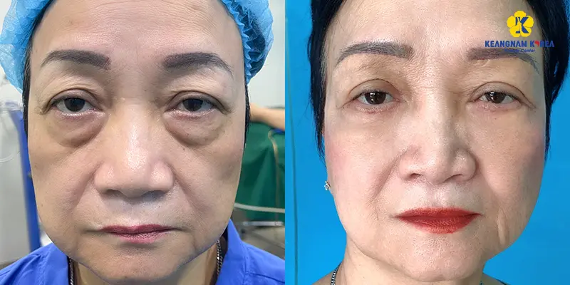 Eye bag fat removal helps rejuvenate and increase facial expression