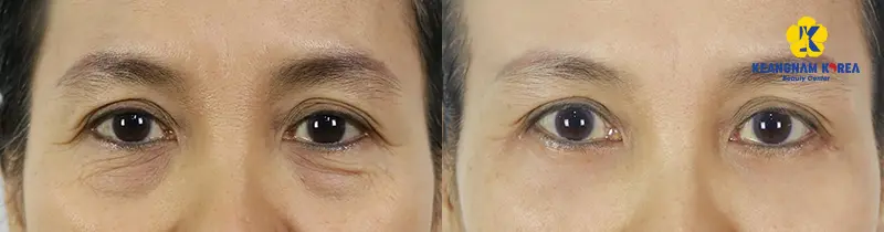 Before and After Removing Under Eye Bags