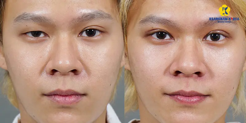 double eyelid surgery for men