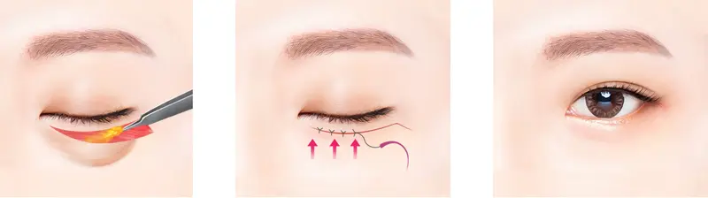 Procedure for Remove Under-Eye Bags 2