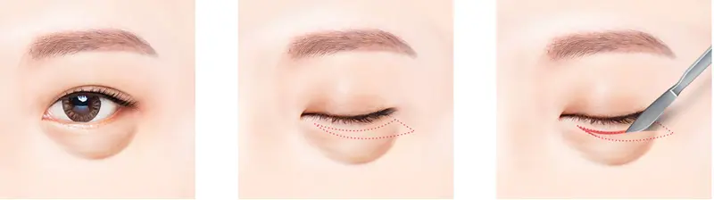 Procedure for Remove Under-Eye Bags