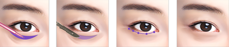 The Lower Eyelid Blepharoplasty Procedure