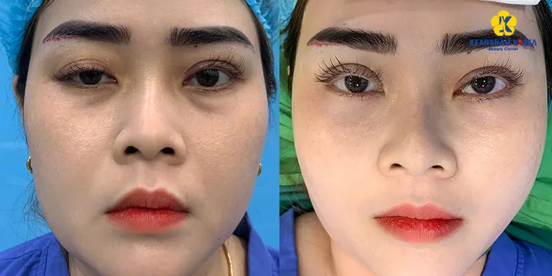 Repairing failed eyelids at Keangnam Korea