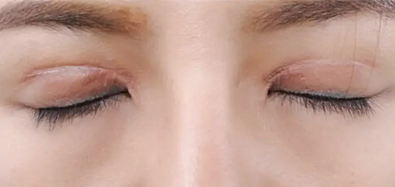 Where is the Best Place for Eyelid Repair?