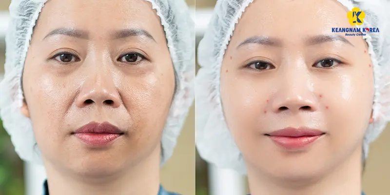 Before and after endoscopic face lift at Keangnam Korea