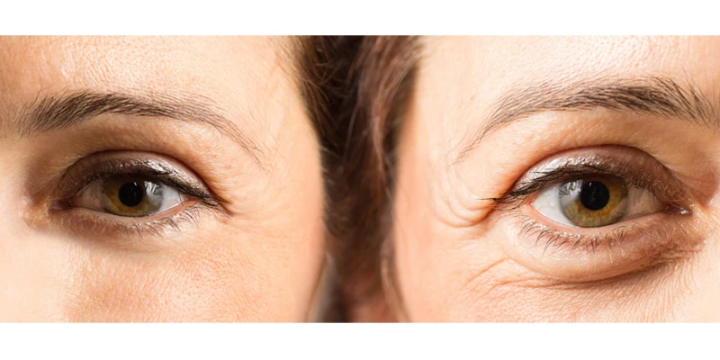 8 Effective Ways to Remove and Treat Crow’s Feet Around the Eyes 1 What Are Crow’s Feet Around the Eyes