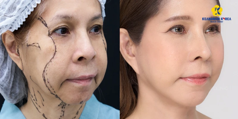 Popular Facelift Surgery Solutions in 2026 2 Current Facelift Surgery Solutions