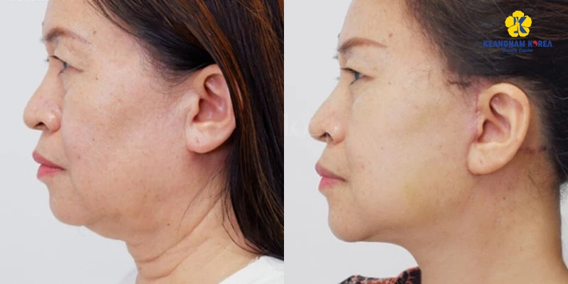 The Latest Neck Skin Tightening Treatment Methods in 2026 4 Neck Lift Using Endoscopic Muscle Tightening
