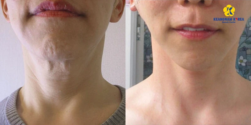 The Latest Neck Skin Tightening Treatment Methods in 2026 2 Who Should Consider Neck Skin Tightening Treatment?