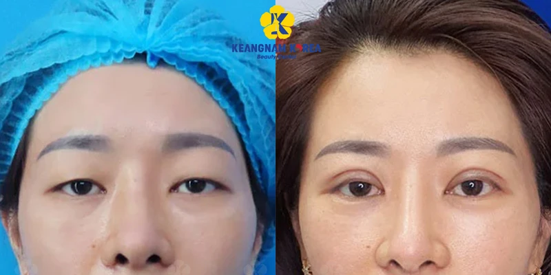 One-Sided Droopy Eyelid Treatment: Should You Choose Double Eyelid Stitching or Surgery? 3 What Is Double Eyelid Stitching?