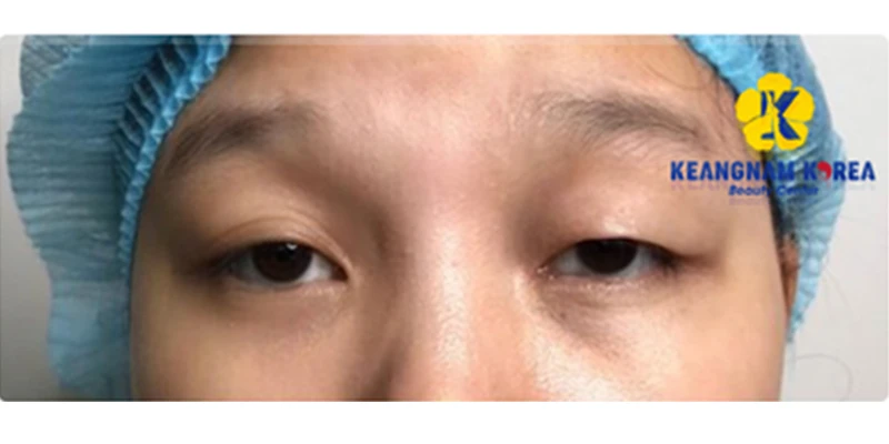 Where Is the Best and Safest Place for Congenital Ptosis Treatment? 2 Effects of Congenital Droopy Eyelids