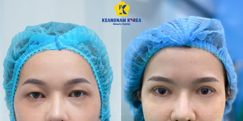 One-Sided Droopy Eyelid Treatment: Should You Choose Double Eyelid Stitching or Surgery? 6 Pros of Double Eyelid Surgery