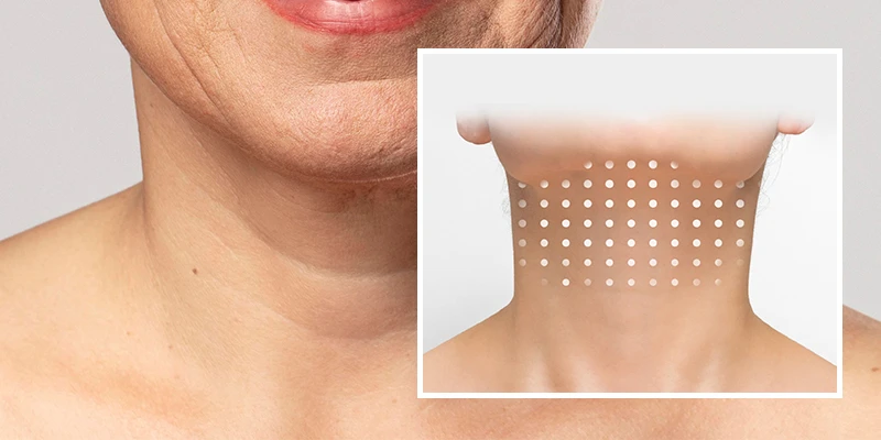 Is Non-Surgical Neck Lift Effective and Worth It? 1 Is Non-Surgical Neck Lift Effective and Worth It