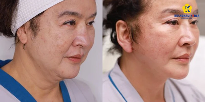 Is Non-Surgical Neck Lift Effective and Worth It? 2 Is Non-Surgical Neck Lift Effective
