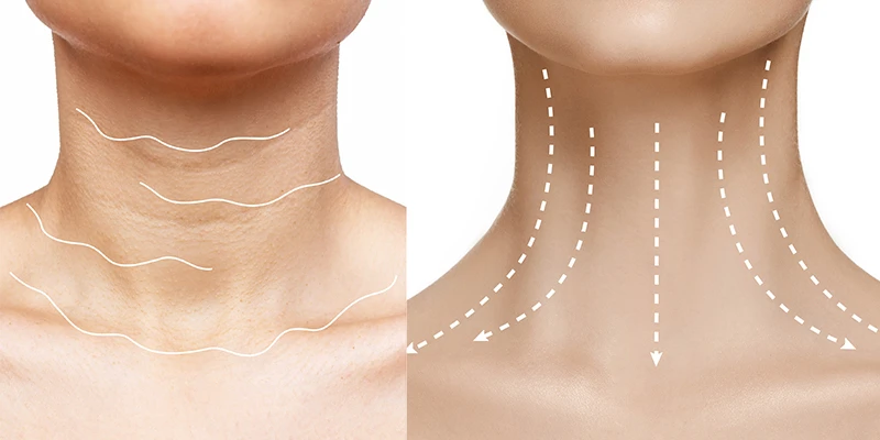 The Latest Neck Skin Tightening Treatment Methods in 2026 3 The Most Modern Neck Skin Tightening Treatments Today