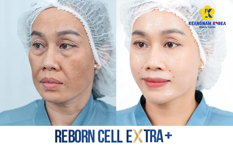 How Much Does a Facelift Cost? Latest Price List for 2026 2 Facial Rejuvenation Technology