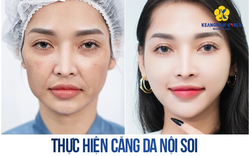 How Much Does a Facelift Cost? Latest Price List for 2026 6 Mini surgery, no scarring, makeup can be applied immediately after the procedure