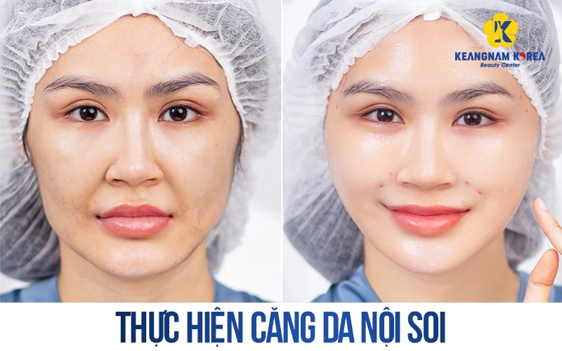 How Much Does a Facelift Cost? Latest Price List for 2026 5 Endoscopic facelift helps improve sagging and drooping skin quickly