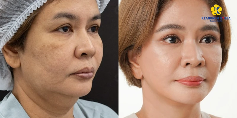 Is Non-Surgical Neck Lift Effective and Worth It? 3 Is Non-Surgical Neck Lift Effective