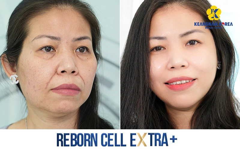 How Much Does a Facelift Cost? Latest Price List for 2026 3 How Much Does a Facelift Cost?