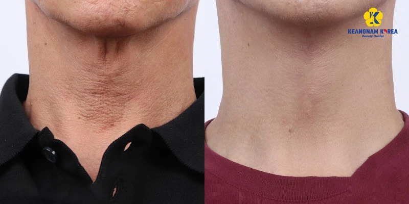 The Latest Neck Skin Tightening Treatment Methods in 2026 5 Non-Surgical Neck Skin Tightening with Reborn Cell Extra+ Technology