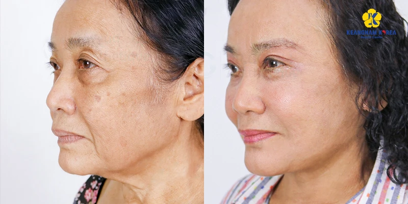 Popular Facelift Surgery Solutions in 2026 3 Full Facelift Surgery