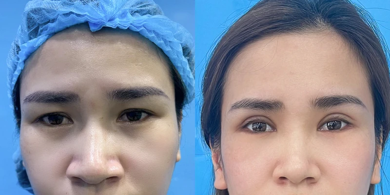 One-Sided Droopy Eyelid Treatment: Should You Choose Double Eyelid Stitching or Surgery? 5 What Is Double Eyelid Surgery