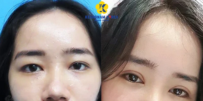 One-Sided Droopy Eyelid Treatment: Should You Choose Double Eyelid Stitching or Surgery? 4 Eyelid surgery only provides temporary improvement