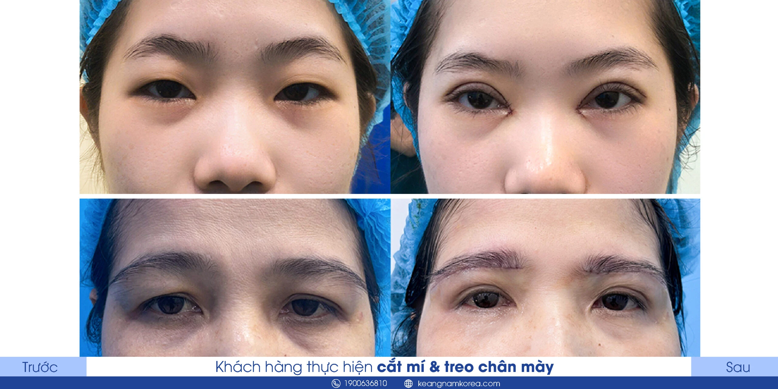 What Is Brow Lift? Who Should Get an Eyebrow Lift? What Are the Benefits? 5 Brow Lift and Eyelid Surgery with Keangnam Korea’s Perfect Eyes Method