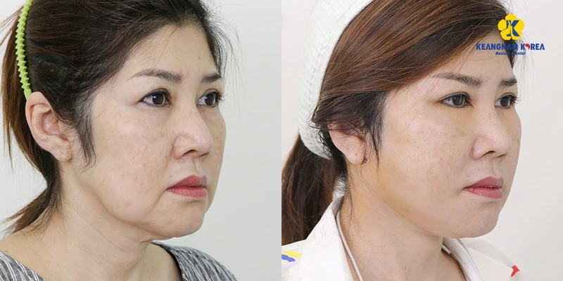 Popular Facelift Surgery Solutions in 2026 5 mini facelift