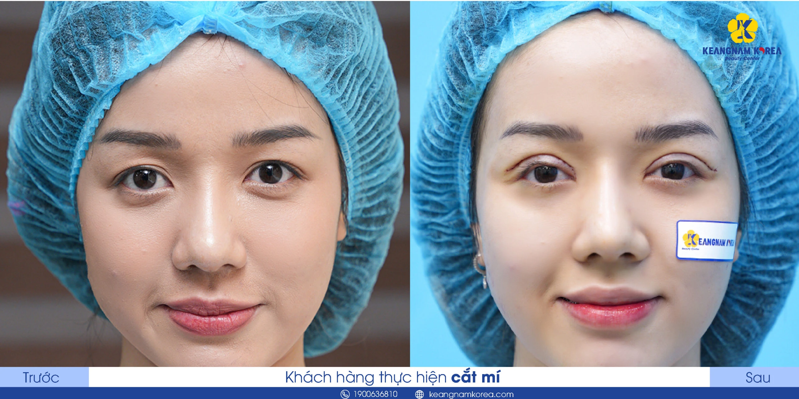 What Is Brow Lift? Who Should Get an Eyebrow Lift? What Are the Benefits? 4 Should You Choose a Brow Lift or Eyelid Surgery