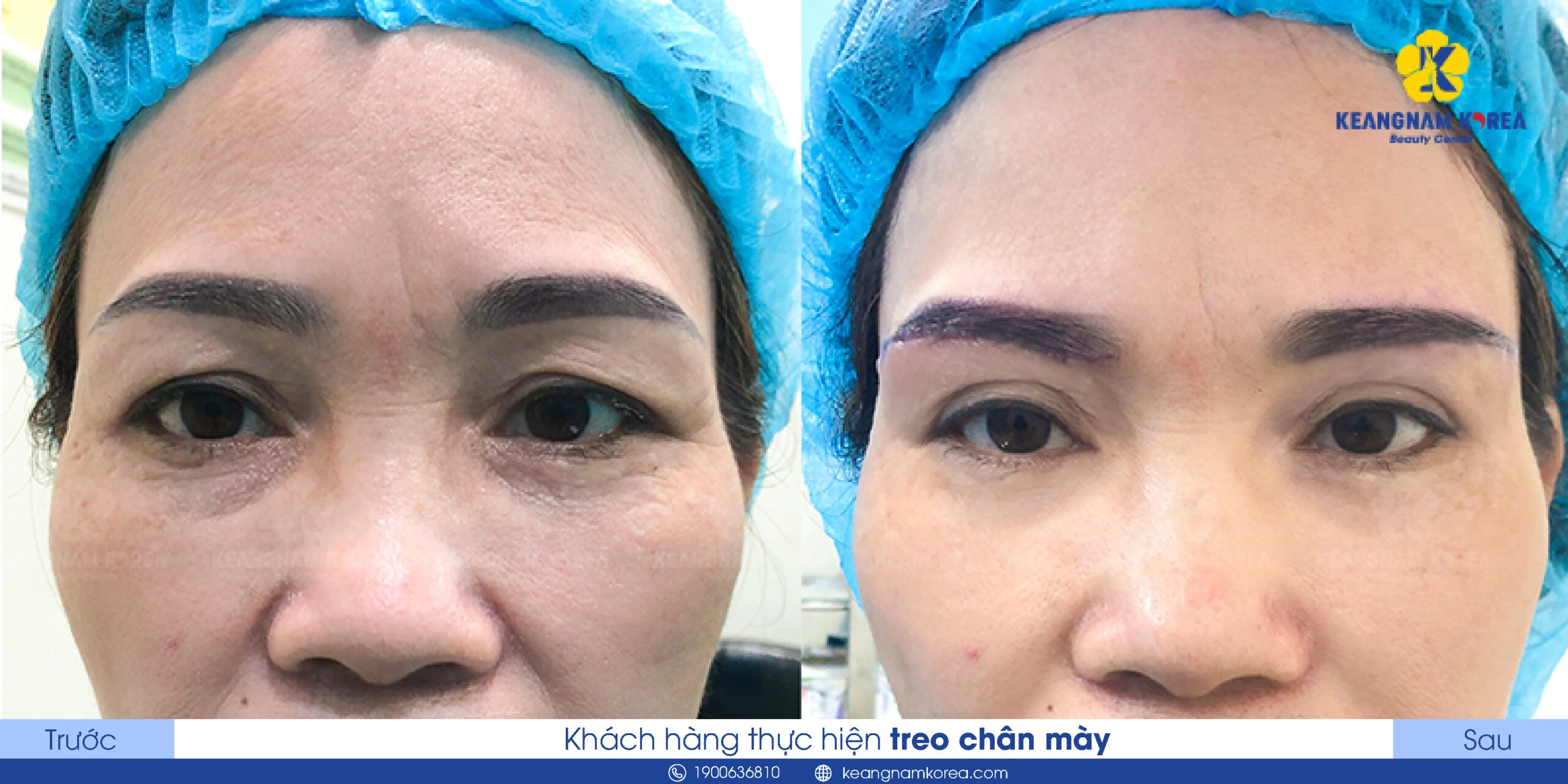 What Is Brow Lift? Who Should Get an Eyebrow Lift? What Are the Benefits? 3 Should You Choose a Brow Lift or Eyelid Surgery