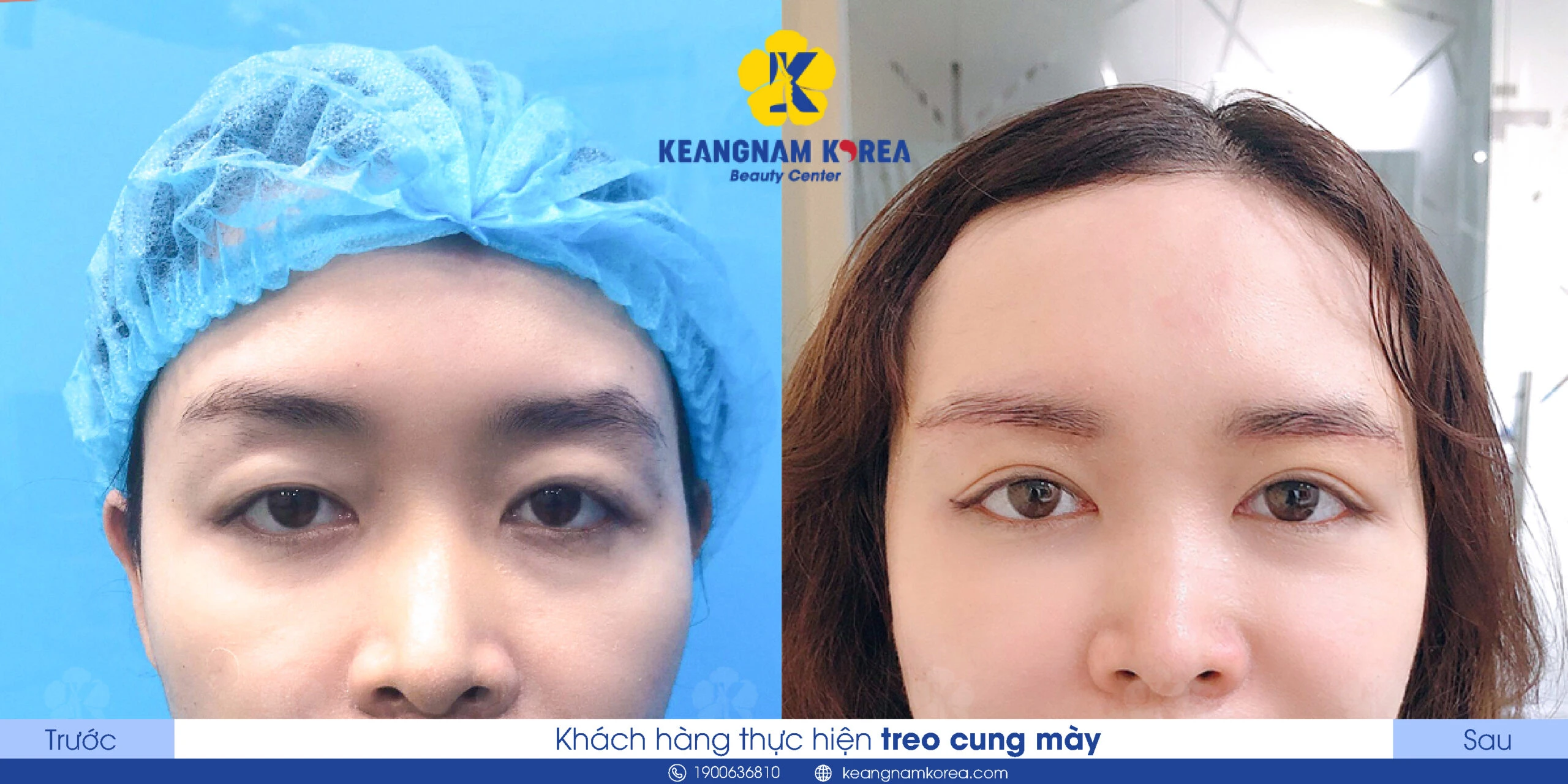 What Is Brow Lift? Who Should Get an Eyebrow Lift? What Are the Benefits? 2 Who Should Consider a Brow Lift?