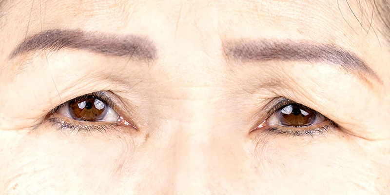 Sudden Droopy Eyelid: 9 Common Causes You Should Not Ignore 1 Ptosis is one of the signs of aging eyes. Sudden droopy eyelid