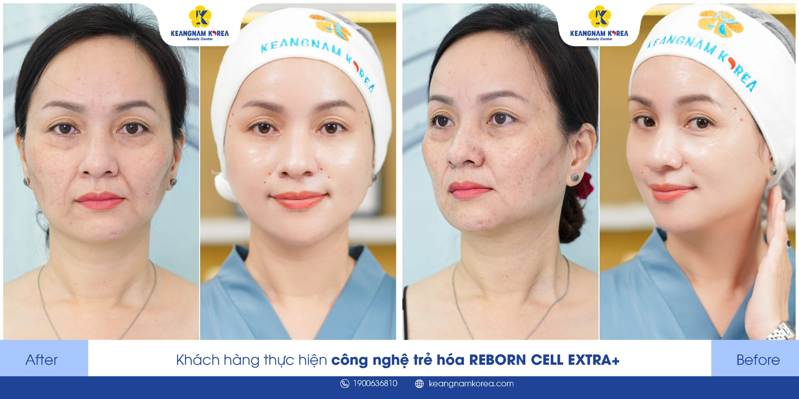 8 Effective Ways to Remove and Treat Crow’s Feet Around the Eyes 5 xoa vet chan chim mat o dau scaled 1