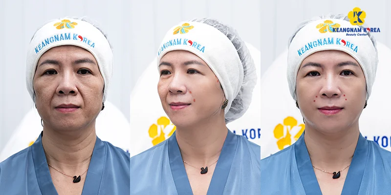 Smile Line Treatment: 7 Ways to Reduce Smile Lines at Home 3 7 cach giam nep nhan khoe mieng tai nha