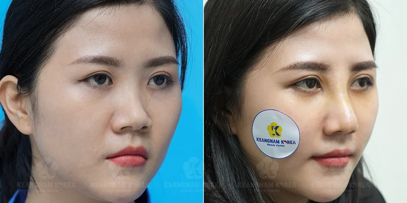 Is Rhinoplasty Expensive? The Latest Rhinoplasty Cost & Pricing in 2026 6 Rib Cartilage Rhinoplasty