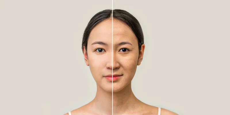 What Causes Nasolabial Folds and Smile Line Wrinkles? | Nasolabial Fold Treatment Guide 1 Common Types of Smile Line Wrinkles