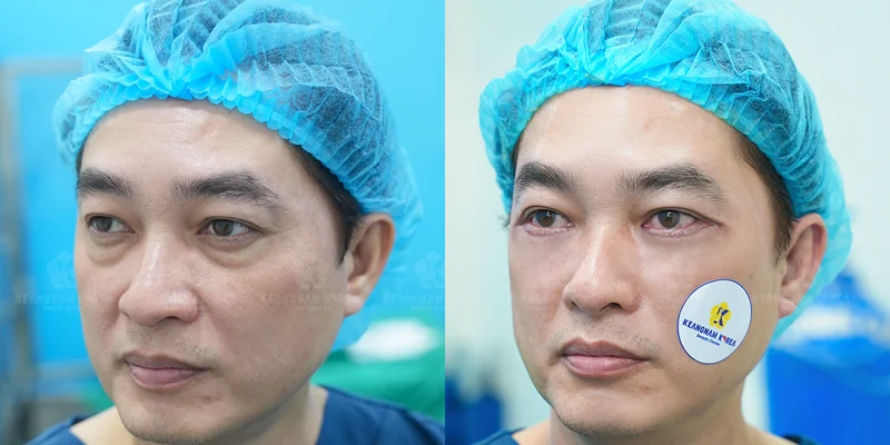 Nose Job First or Double Eyelid Surgery? What to Choose 4 Where Should You Get Double Eyelid Surgery and a Nose Job?