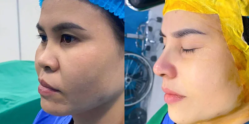 Is Rhinoplasty Expensive? The Latest Rhinoplasty Cost & Pricing in 2026 4 Super Structural Rhinoplasty