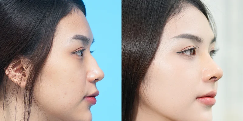 Is Rhinoplasty Expensive? The Latest Rhinoplasty Cost & Pricing in 2026 5 Structural S-Line Rhinoplasty