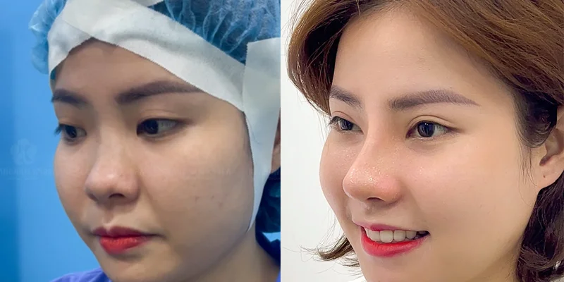 Is Rhinoplasty Expensive? The Latest Rhinoplasty Cost & Pricing in 2026 3 5 Popular Natural Looking Rhinoplasty Techniques