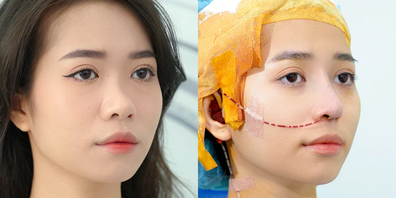 Is Rhinoplasty Expensive? The Latest Rhinoplasty Cost & Pricing in 2026 7 Korean Style Rhinoplasty