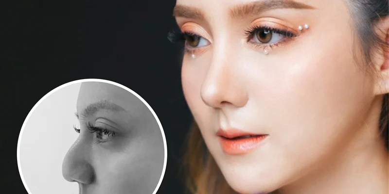 Is Rhinoplasty Worth It? Benefits, Safety & Best Clinic 2 Is Rhinoplasty Permanent?