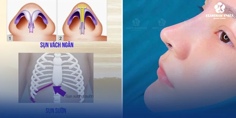 5 Natural Looking Rhinoplasty Services at Keangnam Korea 2 Autologous Rib Cartilage Rhinoplasty